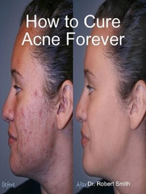 cover image of How to Cure Acne Forever